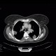 Lymphoma of the lung and spleen: CT - Computed tomography